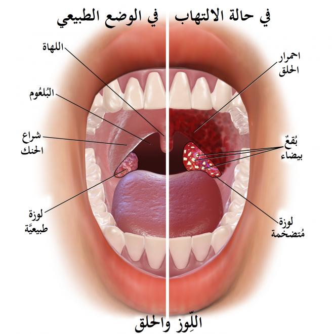 اريد علاج سريع و فعال عشان التهاب الحلق او البلعوم-علاج طبيعى لالتهاب الحلق 1653 1