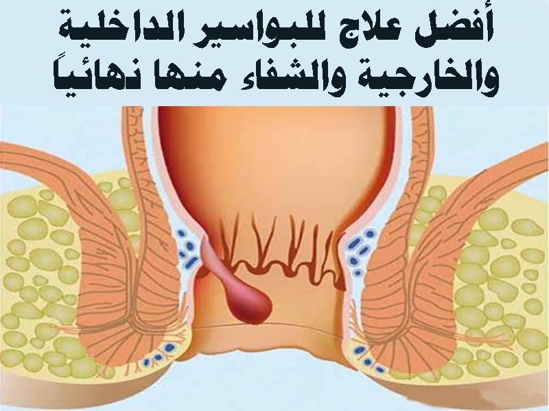 يااهل البواسير المتازمه تعالو لقيت لكم علااج 1844 1