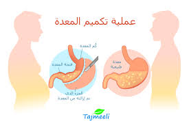 تجارب عملية التكميم , اهم عملية للمعدة