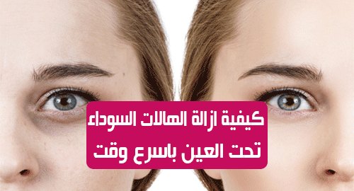 علاج الهالات السوداء تحت العين نهائيا , طريقة سريعة للتخلص من الهالات السوداء تحت العين