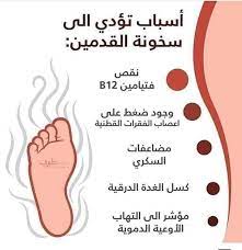 حرارة باطن القدم 1503