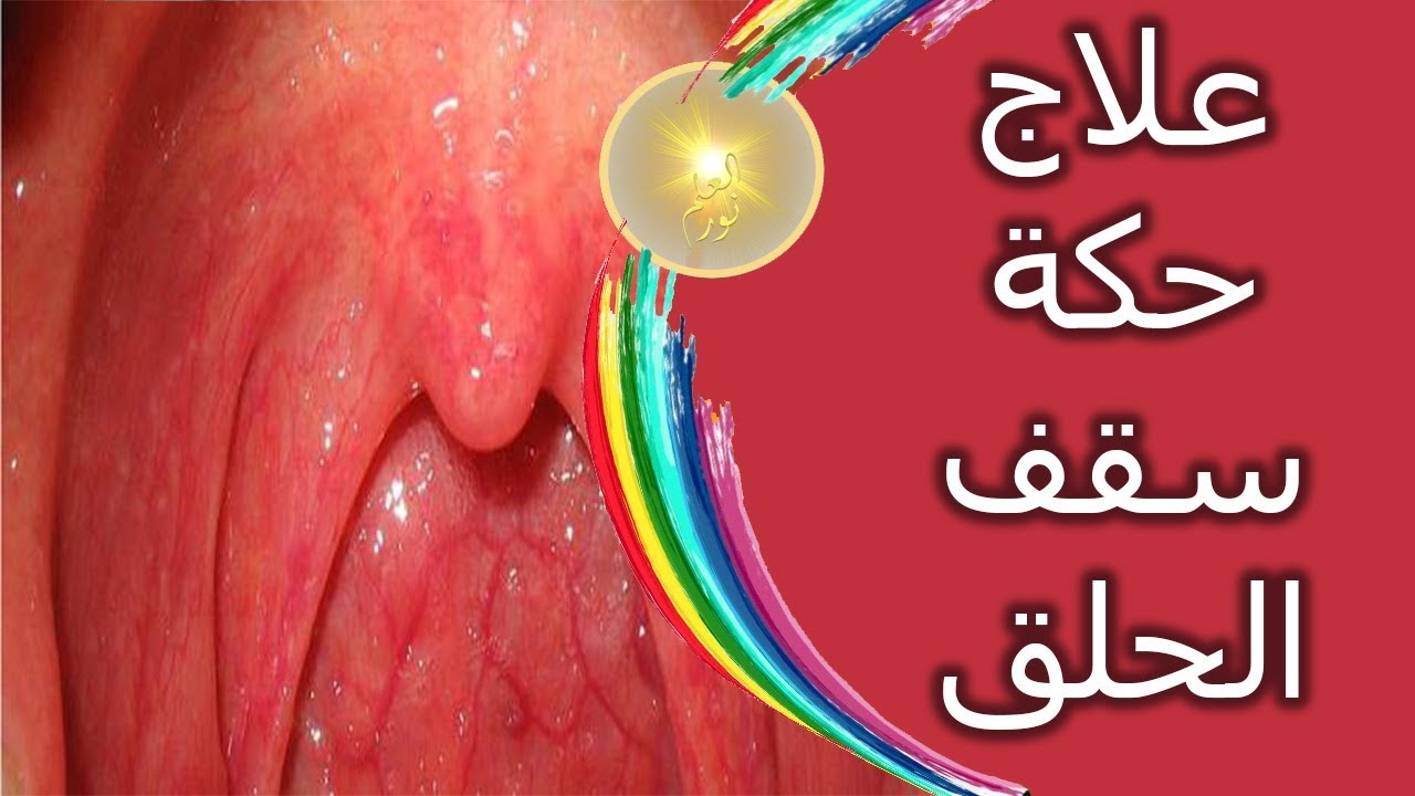 ابي علاج لحكة الحلق 1260